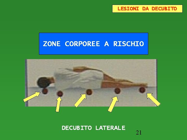 LESIONI DA DECUBITO ZONE CORPOREE A RISCHIO DECUBITO LATERALE 21 