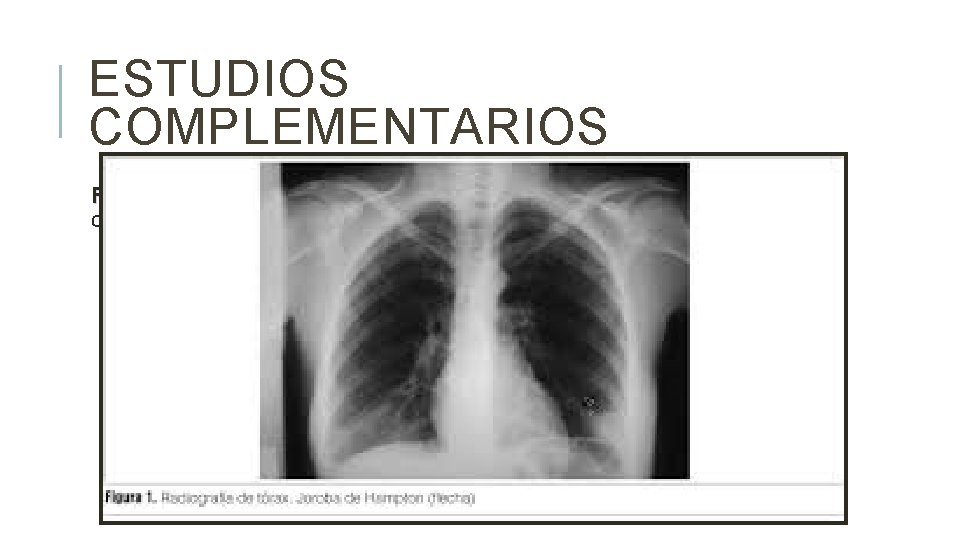 ESTUDIOS COMPLEMENTARIOS RX tórax: Radiopacidad heterogénea en base pulmonar izquierda con forma tórax de