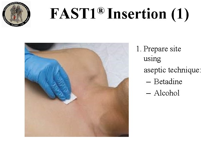 ® FAST 1 Insertion (1) 1. Prepare site using aseptic technique: – Betadine – ® FAST 1 Insertion (1) 1. Prepare site using aseptic technique: – Betadine –