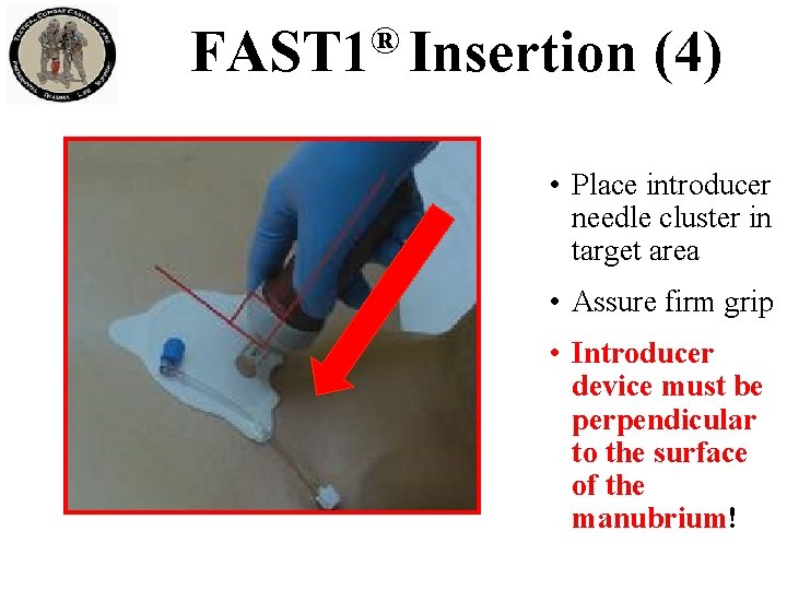 ® FAST 1 Insertion (4) • Place introducer needle cluster in target area • ® FAST 1 Insertion (4) • Place introducer needle cluster in target area •