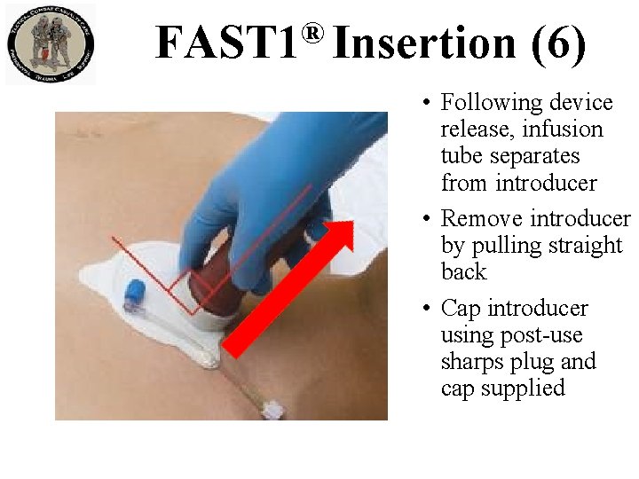 ® FAST 1 Insertion (6) • Following device release, infusion tube separates from introducer ® FAST 1 Insertion (6) • Following device release, infusion tube separates from introducer