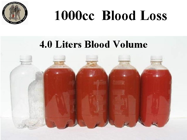 1000 cc Blood Loss 4. 0 Liters Blood Volume 1000 cc Blood Loss 4. 0 Liters Blood Volume