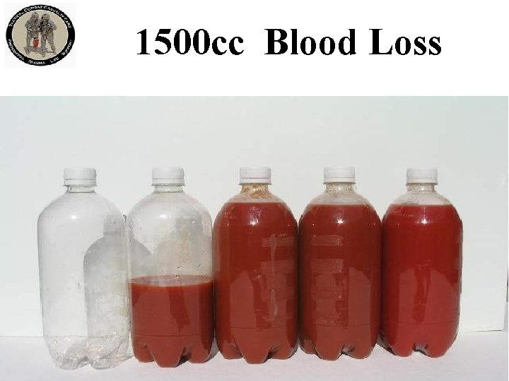 1500 cc Blood Loss 3. 5 Liters Blood Volume 1500 cc Blood Loss 3. 5 Liters Blood Volume