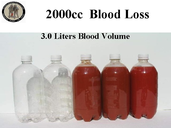 2000 cc Blood Loss 3. 0 Liters Blood Volume 2000 cc Blood Loss 3. 0 Liters Blood Volume