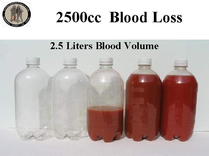 2500 cc Blood Loss 2. 5 Liters Blood Volume 2500 cc Blood Loss 2. 5 Liters Blood Volume