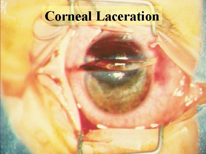 Corneal Laceration Corneal Laceration
