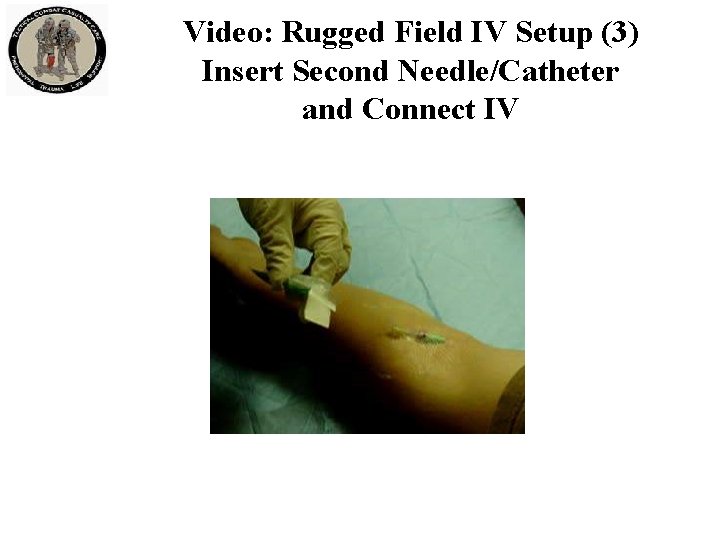 Video: Rugged Field IV Setup (3) Insert Second Needle/Catheter and Connect IV Video: Rugged Field IV Setup (3) Insert Second Needle/Catheter and Connect IV
