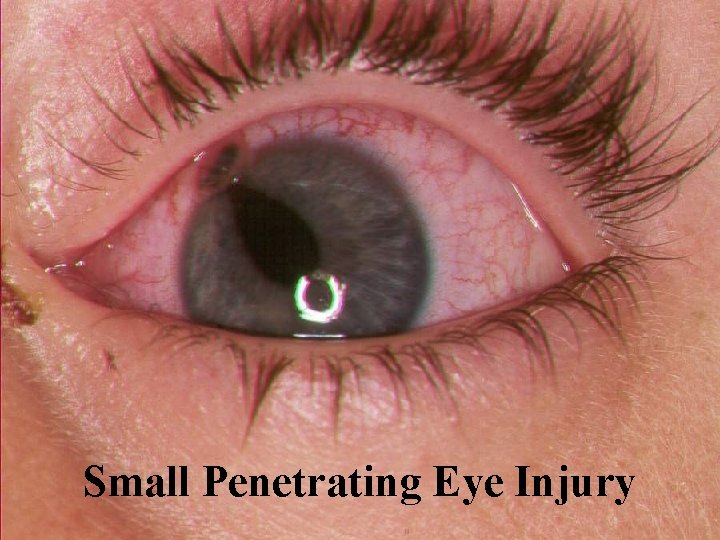 Small Penetrating Eye Injury Small Penetrating Eye Injury