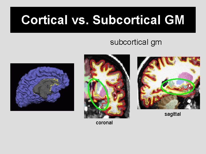 Cortical vs. Subcortical GM subcortical gm sagittal coronal 