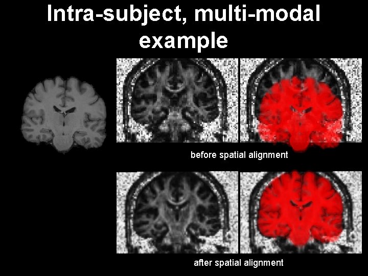 Intra-subject, multi-modal example before spatial alignment after spatial alignment 