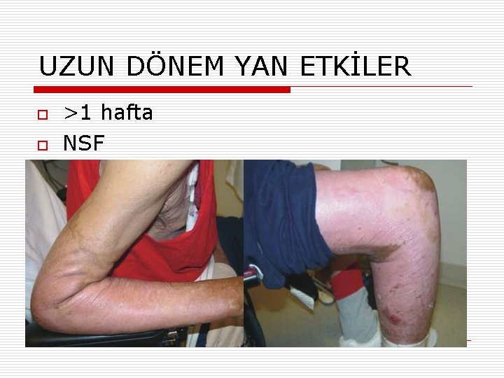 UZUN DÖNEM YAN ETKİLER o o >1 hafta NSF 