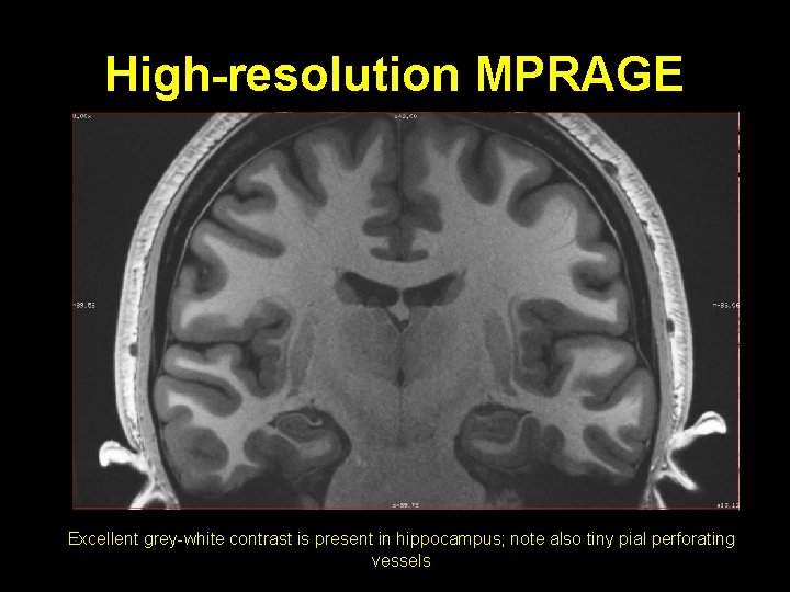 High-resolution MPRAGE Excellent grey-white contrast is present in hippocampus; note also tiny pial perforating