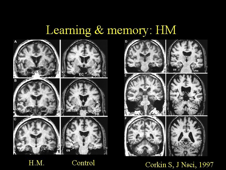 Learning & memory: HM H. M. Control Corkin S, J Nsci, 1997 