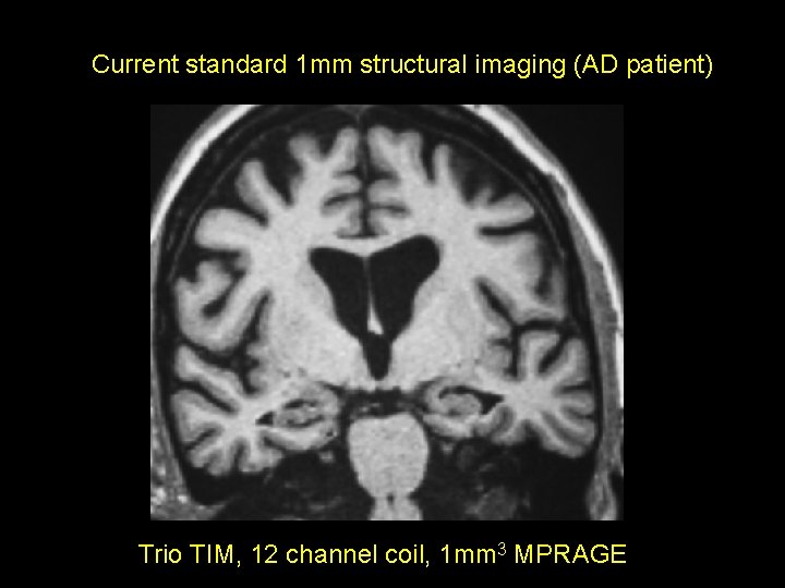 Current standard 1 mm structural imaging (AD patient) Trio TIM, 12 channel coil, 1
