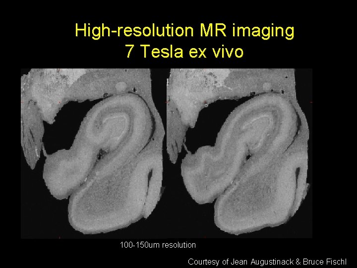 High-resolution MR imaging 7 Tesla ex vivo 100 -150 um resolution Courtesy of Jean