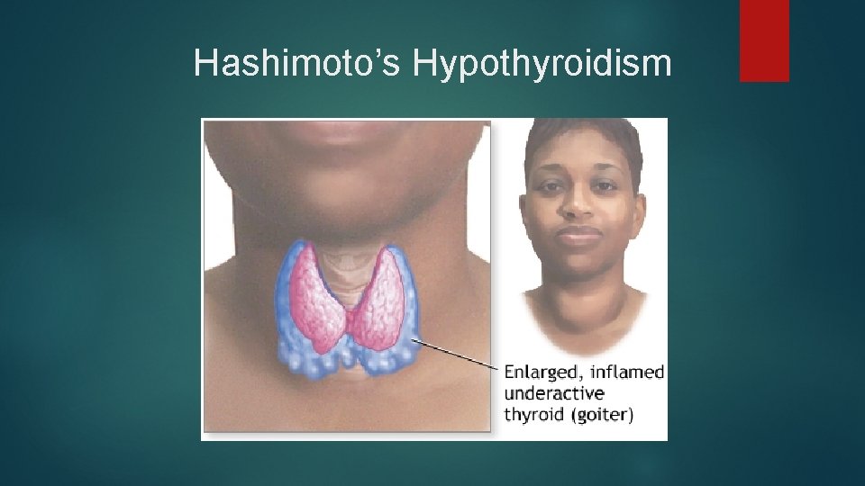 Hashimoto’s Hypothyroidism 