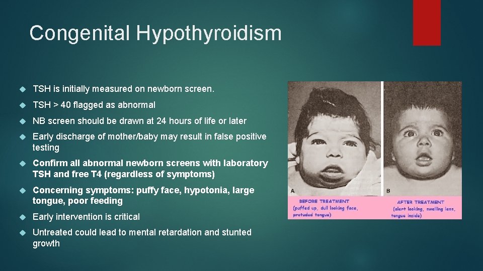 Congenital Hypothyroidism TSH is initially measured on newborn screen. TSH > 40 flagged as