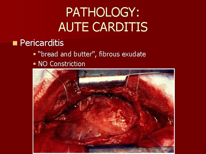 PATHOLOGY: AUTE CARDITIS n Pericarditis § “bread and butter”, fibrous exudate § NO Constriction