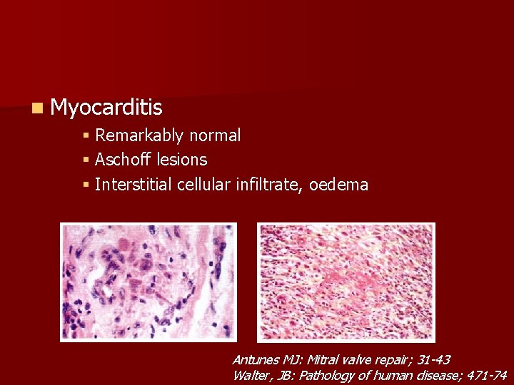 n Myocarditis § Remarkably normal § Aschoff lesions § Interstitial cellular infiltrate, oedema Antunes