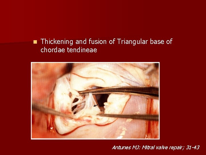 n Thickening and fusion of Triangular base of chordae tendineae Antunes MJ: Mitral valve