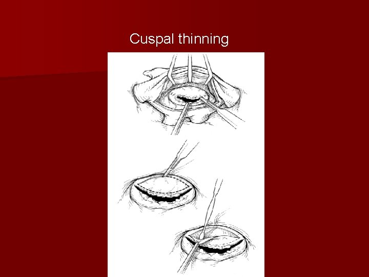 Cuspal thinning 