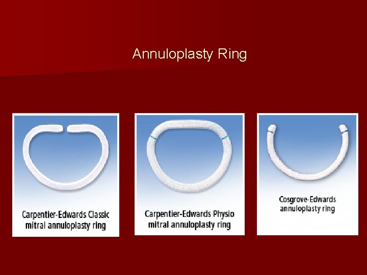 Annuloplasty Ring 