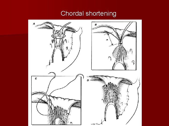 Chordal shortening 