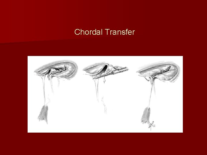 Chordal Transfer 