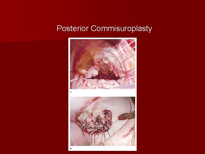 Posterior Commisuroplasty 