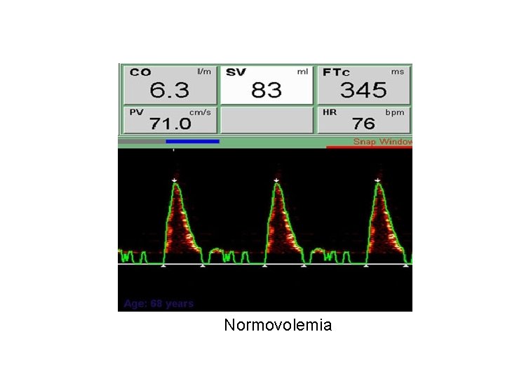 Normovolemia 