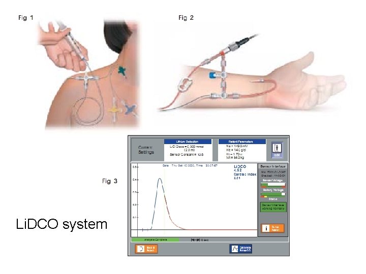 Li. DCO system 