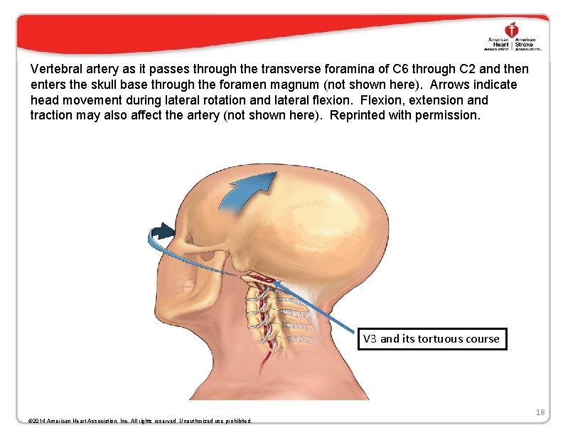 Vertebral artery as it passes through the transverse foramina of C 6 through C Vertebral artery as it passes through the transverse foramina of C 6 through C