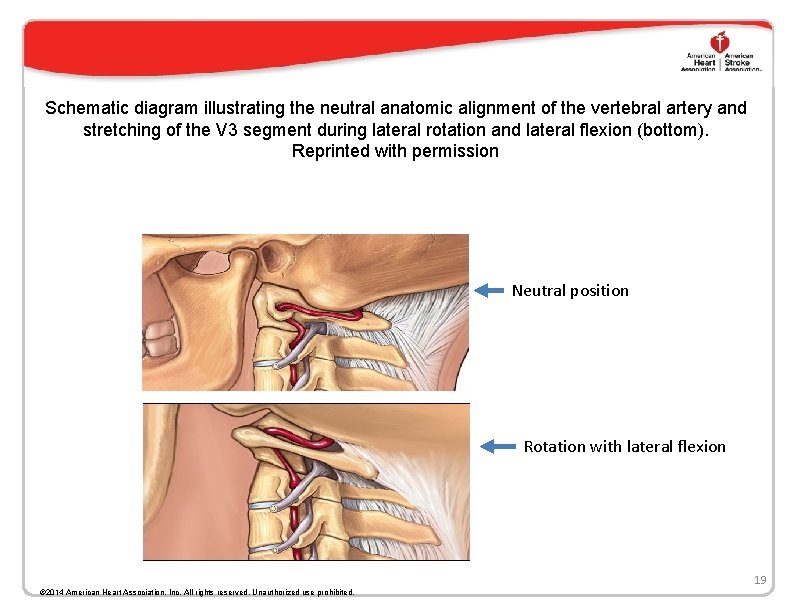 Schematic diagram illustrating the neutral anatomic alignment of the vertebral artery and stretching of