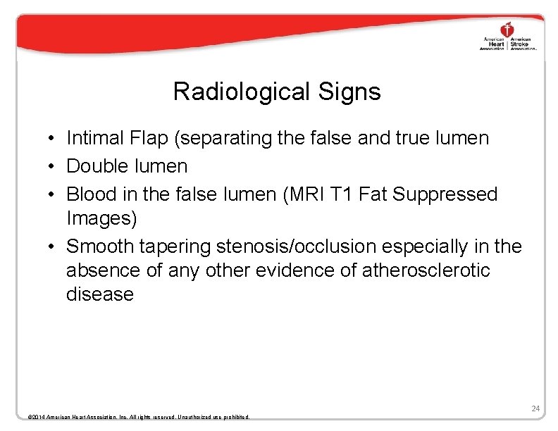 Radiological Signs • Intimal Flap (separating the false and true lumen • Double lumen