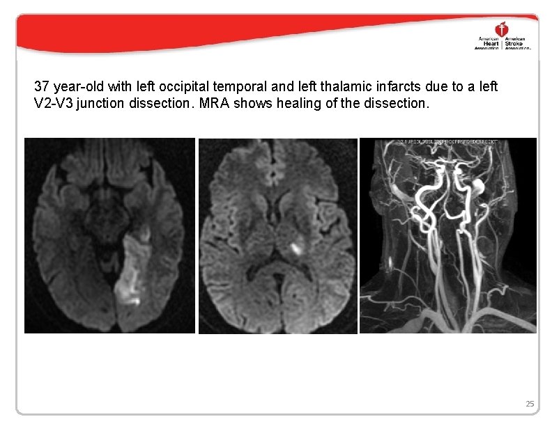 37 year-old with left occipital temporal and left thalamic infarcts due to a left