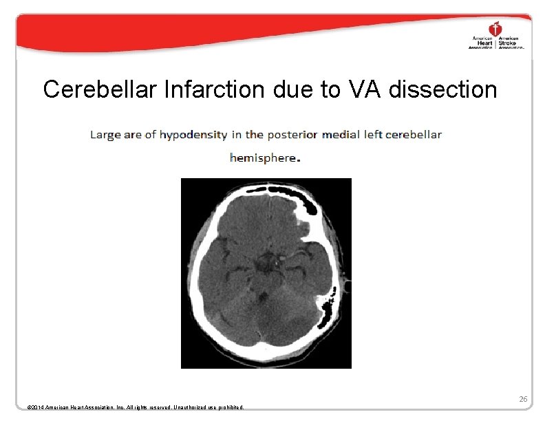 Cerebellar Infarction due to VA dissection 26 © 2014 American Heart Association, Inc. All