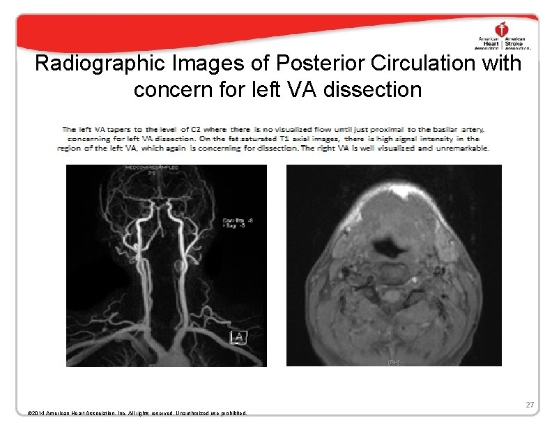 Radiographic Images of Posterior Circulation with concern for left VA dissection 27 © 2014