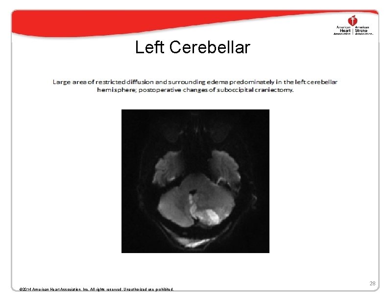 Left Cerebellar 28 © 2014 American Heart Association, Inc. All rights reserved. Unauthorized use