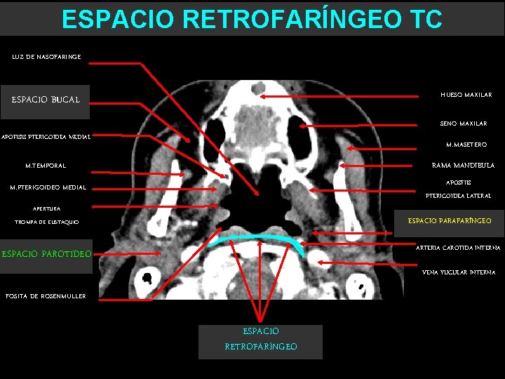 ESPACIO RETROFARÍNGEO TC LUZ DE NASOFARINGE ESPACIO BUCAL HUESO MAXILAR SENO MAXILAR APOFISIS PTERIGOIDEA