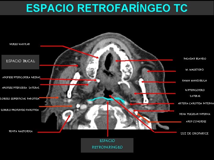 ESPACIO RETROFARÍNGEO TC HUESO MAXILAR PALADAR BLANDO ESPACIO BUCAL M. MASETERO APOFISIS PTERIGOIDEA MEDIAL