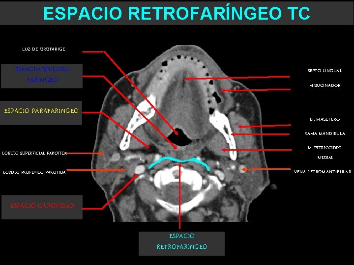 ESPACIO RETROFARÍNGEO TC LUZ DE OROFARIGE ESPACIO MUCOSO FARINGEO SEPTO LINGUAL M. BUCINADOR ESPACIO