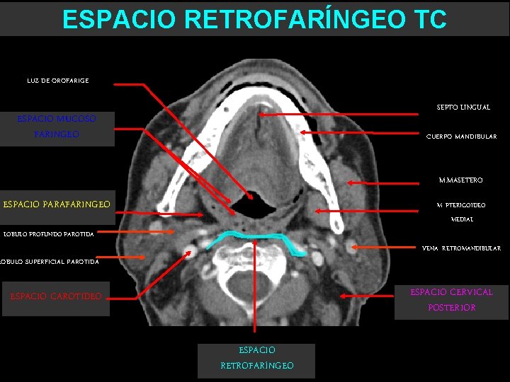 ESPACIO RETROFARÍNGEO TC LUZ DE OROFARIGE SEPTO LINGUAL ESPACIO MUCOSO FARINGEO CUERPO MANDIBULAR M.