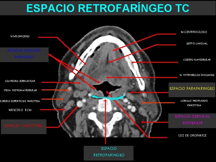 ESPACIO RETROFARÍNGEO TC M. GENIHIOGLOSO M. MILOHIODEO SEPTO LINGUAL ESPACIO MUCOSO FARINGEO CUERPO MANDIBULAR