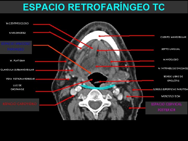 ESPACIO RETROFARÍNGEO TC M. GENIHIOGLOSO M. MILOHIODEO ESPACIO MUCOSO FARINGEO M. PLATISMA GLANDULA SUBMANDIBULAR