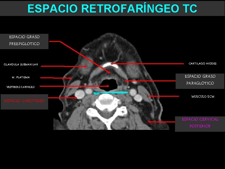 ESPACIO RETROFARÍNGEO TC ESPACIO GRASO PREEPIGLOTICO GLANDULA SUBMAXILAR M. PLATISMA VESTIBULO LARINGEO ESPACIO CAROTIDEO