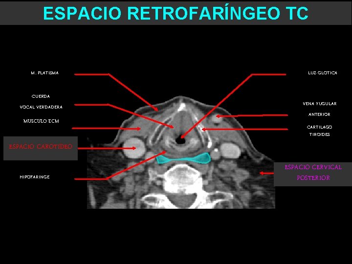 ESPACIO RETROFARÍNGEO TC M. PLATISMA CUERDA VOCAL VERDADERA MUSCULO ECM LUZ GLOTICA VENA YUGULAR