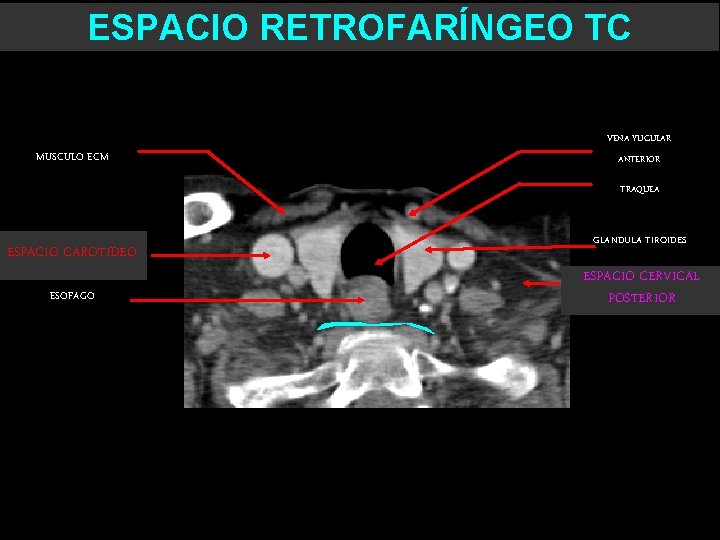 ESPACIO RETROFARÍNGEO TC VENA YUGULAR MUSCULO ECM ANTERIOR TRAQUEA ESPACIO CAROTIDEO ESOFAGO GLANDULA TIROIDES