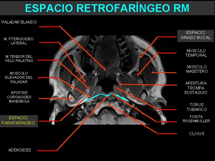 ESPACIO RETROFARÍNGEO RM PALADAR BLANDO M. PTERIGOIDEO LATERAL M. TENSOR DEL VELO PALATINO MUSCULO