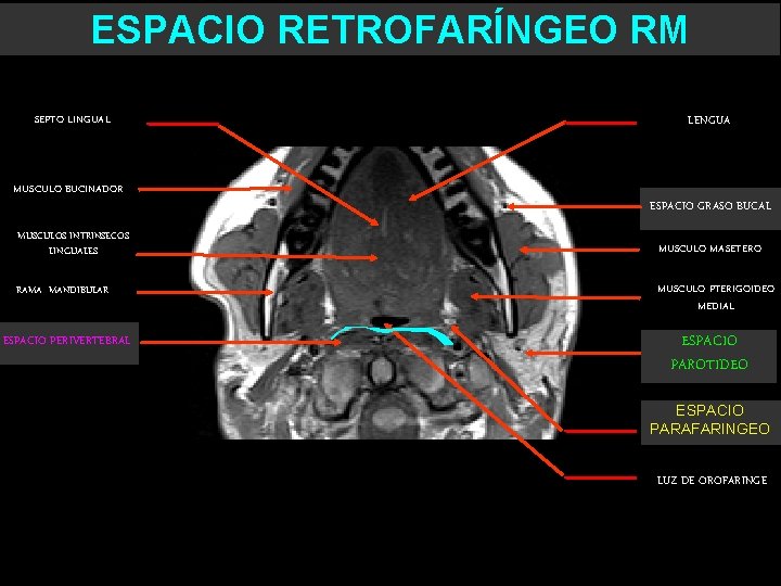 ESPACIO RETROFARÍNGEO RM SEPTO LINGUAL MUSCULO BUCINADOR MUSCULOS INTRINSECOS LINGUALES RAMA MANDIBULAR ESPACIO PERIVERTEBRAL