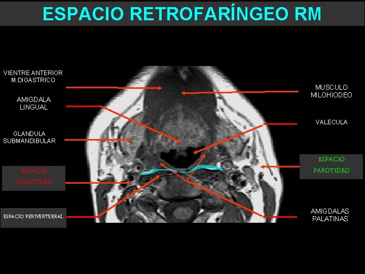 ESPACIO RETROFARÍNGEO RM VIENTRE ANTERIOR M. DIGASTRICO AMIGDALA LINGUAL MUSCULO MILOHIODEO VALECULA GLANDULA SUBMANDIBULAR